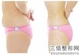 上海动氧瘦臀部美容价格是多少(2022年09月动氧瘦臀部均价为：4710元)