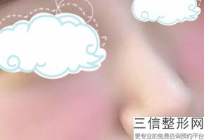 上海短鼻矫正术整形现在费用(2022年09月短鼻矫正术均价为：4450元)