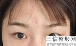 上海多点定位双眼皮整形价格查询(2022年09月多点定位双眼皮均价为：4331元)
