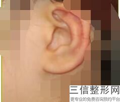 上海耳部整形整形现在价位(2022年09月耳部整形均价为：4398元)