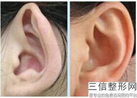 上海耳垂分离术美容多少钱贵不贵(2022年09月耳垂分离术均价为：4483元)