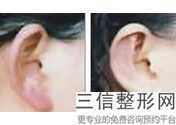 上海耳垂裂矫正整容价格是有多少(2022年09月耳垂裂矫正均价为：4530元)