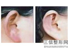 上海耳垂缺损修复整形的价格盘点(2022年09月耳垂缺损修复均价为：4602元)