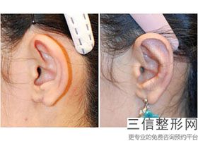 上海耳朵矫正整形手术美容价格介绍(2022年09月耳朵矫正整形手术均价为：4351元)