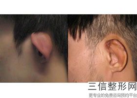 上海耳朵缺损修补整形价格会是多少(2022年09月耳朵缺损修补均价为：4645元)