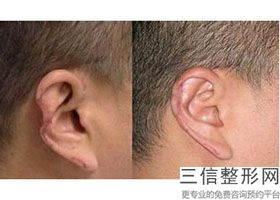 上海耳朵缺损修补整形正常价格参考(2022年09月耳朵缺损修补均价为：4195元)
