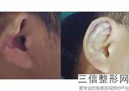 上海耳复合美容多少钱能做出来(2022年09月耳复合均价为：4626元)