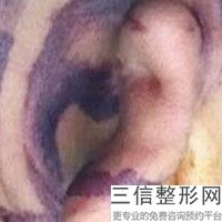 上海耳畸形再造整形价格是什么(2022年09月耳畸形再造均价为：4551元)