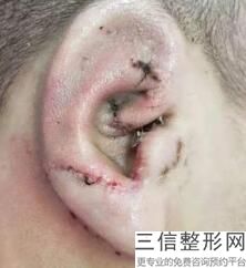 上海耳矫正美容要花多少价钱(2022年09月耳矫正均价为：4805元)