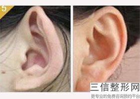 上海耳矫正整形花多少钱(2022年09月耳矫正均价为：4435元)