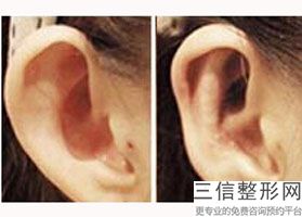 上海耳廓缺损修复美容费用多少钱(2022年09月耳廓缺损修复均价为：4304元)