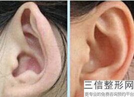 上海耳廓再造副耳整容费用范围(2022年09月耳廓再造副耳均价为：4436元)