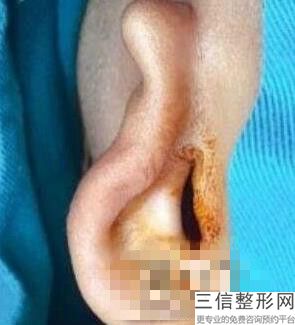 上海耳廓再造术耳朵整形通常价格费用(2022年09月耳廓再造术耳朵均价为：4490元)