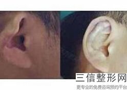 杯状耳矫正器哪个牌子好，杯状耳整形手术