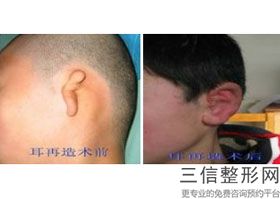 杯状耳手术失败案例，杯状耳手术后多久恢复