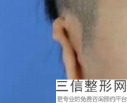 杯状耳手术失败案例，杯状耳手术后多久恢复