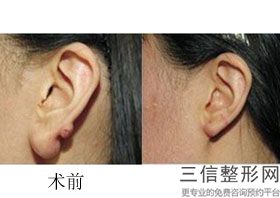 杯状耳需要治疗吗，杯状耳矫正术