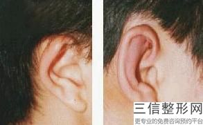 杯状耳需要治疗吗，杯状耳矫正术