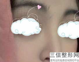 玻尿酸垫鼻根怎么样，玻尿酸垫鼻梁会有什么后遗症