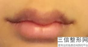 玻尿酸丰唇塑形，丰唇用什么玻尿酸