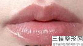 玻尿酸丰唇塑形，丰唇用什么玻尿酸