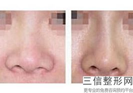 玻尿酸隆鼻后肿胀，玻尿酸隆鼻红肿
