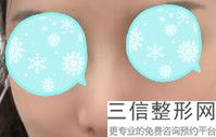 玻尿酸隆鼻可以注射鼻头吗，玻尿酸隆鼻注射方法