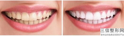 补牙过程分为几个步骤，补牙需要什么过程