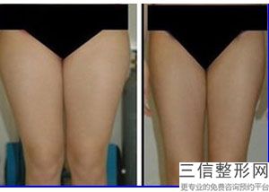 大腿部抽脂塑身，抽脂塑形小腿