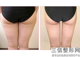 大腿部抽脂塑身，抽脂塑形小腿