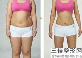 大腿部抽脂塑身，抽脂塑形小腿