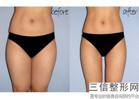 大腿吸脂手术方法,女性大腿吸脂手术全过程
