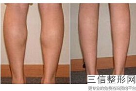 大腿吸脂手术方法,女性大腿吸脂手术全过程