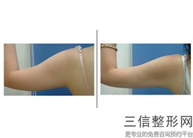 大腿吸脂术后有哪些注意事项(大腿吸脂术后恢复期需要注意什么)？_1