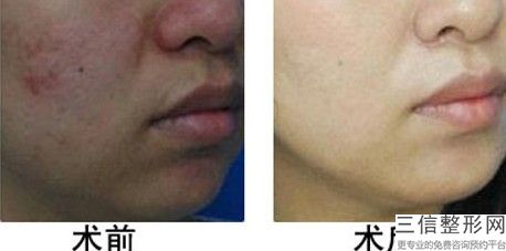 电波拉皮去眼下皱纹，电波拉皮去抬头纹
