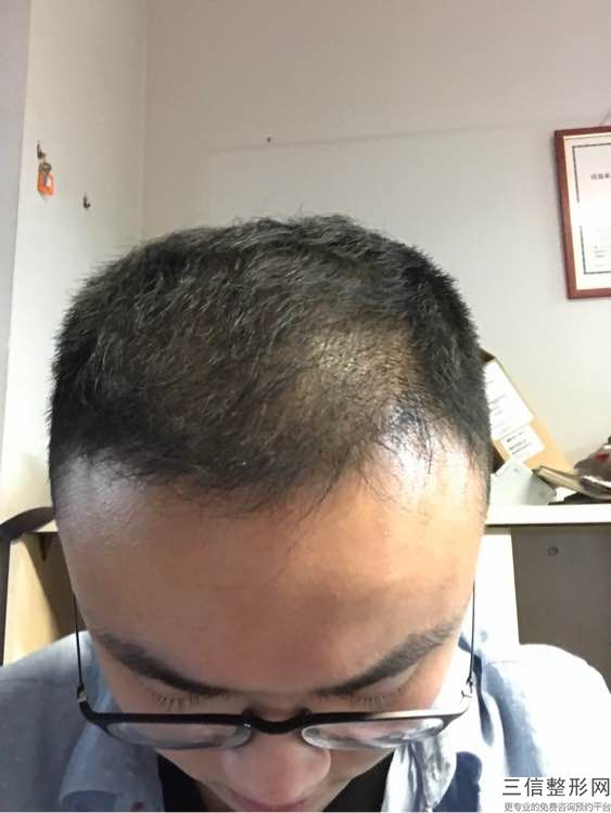 东莞哪家医院整形技术好，东莞植发医院哪家医技术好