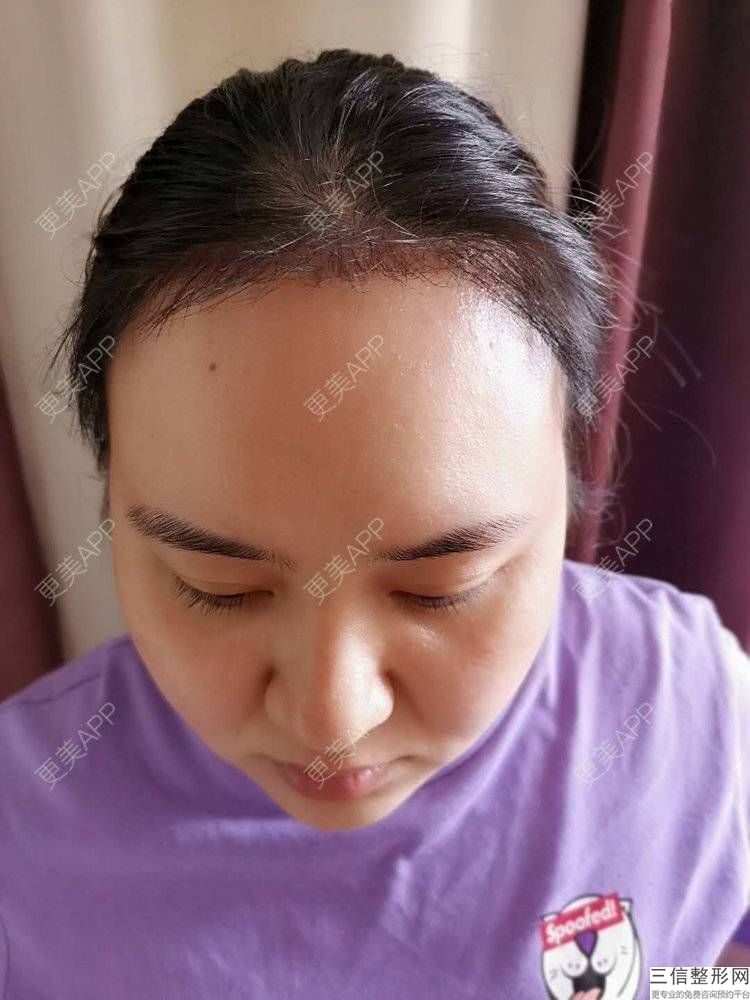 东莞哪家医院整形技术好，东莞植发医院哪家医技术好