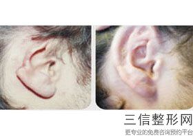 耳朵能整形做大吗，整容可以整耳朵吗-