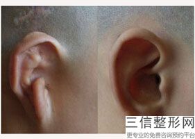 耳朵能整形做大吗，整容可以整耳朵吗-