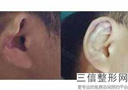耳廓再造术后护理，耳廓重建手术成功率