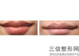 丰上唇的方法有哪些，丰唇有几种方法