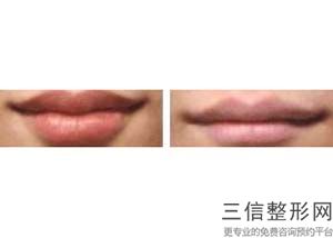 丰上唇的方法有哪些，丰唇有几种方法