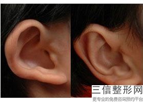 福州耳朵畸形哪家医院好，福州市哪家医院看耳朵比较好