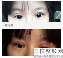 割了双眼皮感觉变老了，为什么割完双眼皮变老了