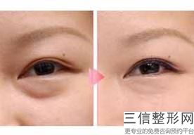 割了双眼皮感觉变老了，为什么割完双眼皮变老了