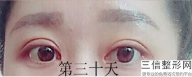 割双眼皮为什么不留疤,割双眼皮怎么样才能不留疤