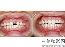 广州哪家牙科医院整牙好，广州牙齿整形哪家医院良好