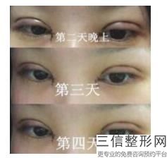 贵阳割双眼皮哪里好，贵阳哪家做双眼皮