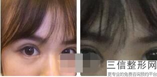 贵阳割双眼皮哪里好，贵阳哪家做双眼皮