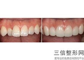 贵阳口腔医院烤瓷牙多少钱一颗，贵阳口腔医院全瓷牙多少钱